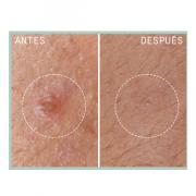Miniatura - LIERAC PROTOCOLO ANTI IMPERFECCIONES AC.SALICILICO PURO STOP GRANOS (25ML)