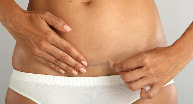 B.BRAUN KIT ASKINA® C-SECTION cicatrices post-cesárea