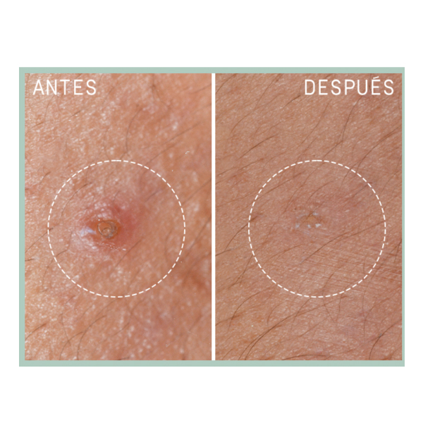 LIERAC PROTOCOLO ANTI IMPERFECCIONES AC.SALICILICO PURO STOP GRANOS (25ML)