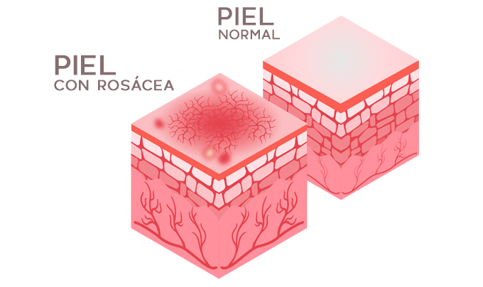 POST-ROSACEA