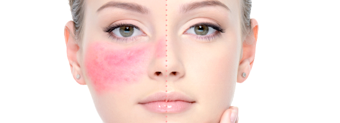 POST-ROSACEA