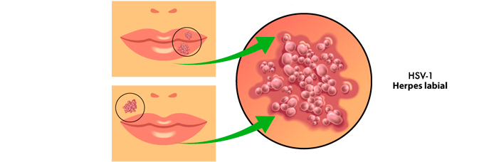 POST-HERPES-LABIOS