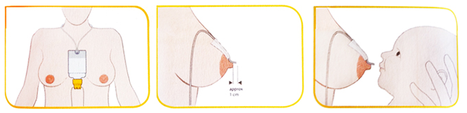 Comprar Medela Relactador Sistema de Nutrición Suplementaria