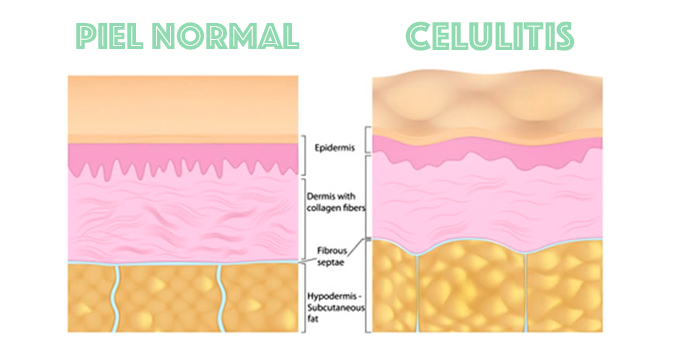 post dieta contra la celulitis